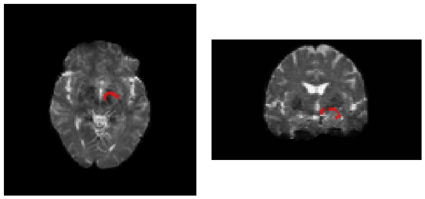 Warped anterior atlas
