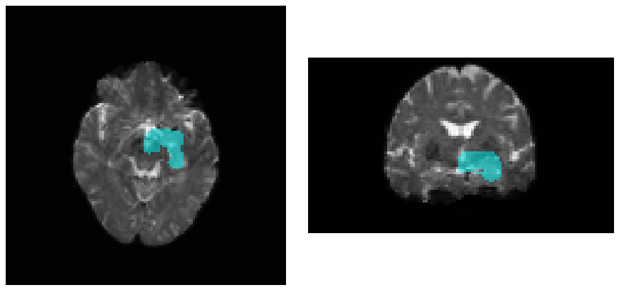 Inclusion zone over the mean b = 0 image