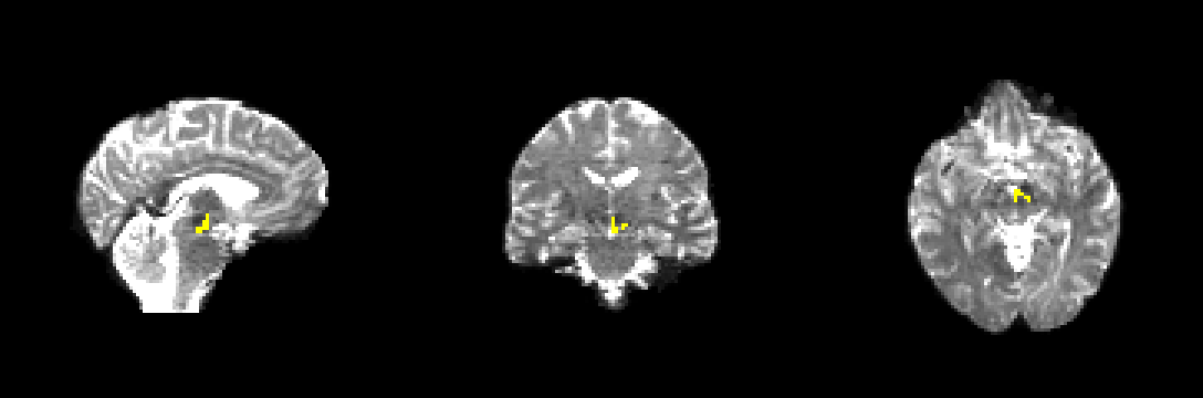 Whole-brain view of the warped left VTA